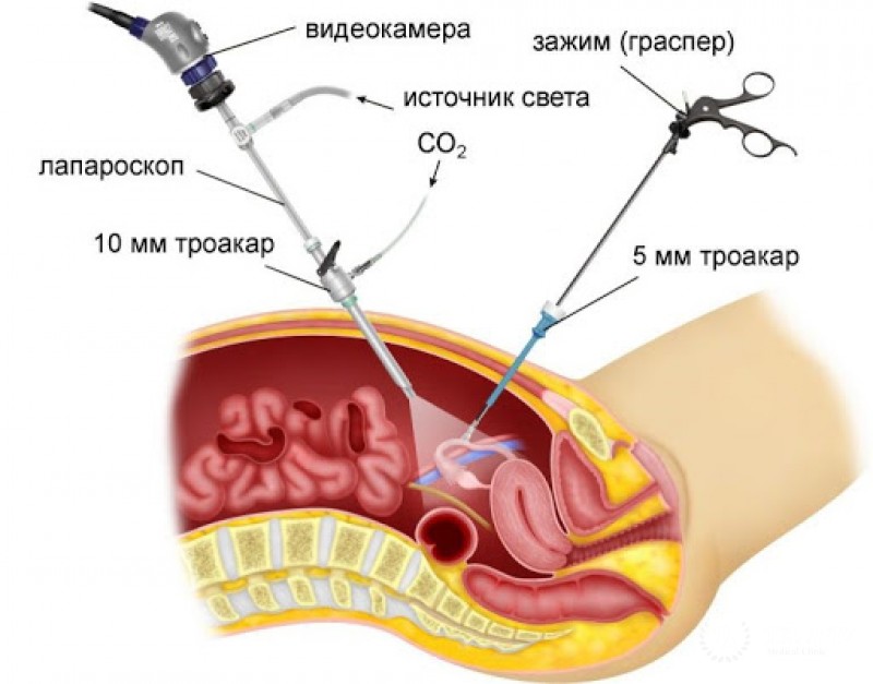 Лапароскопия для сохранения яичника и маточной трубы