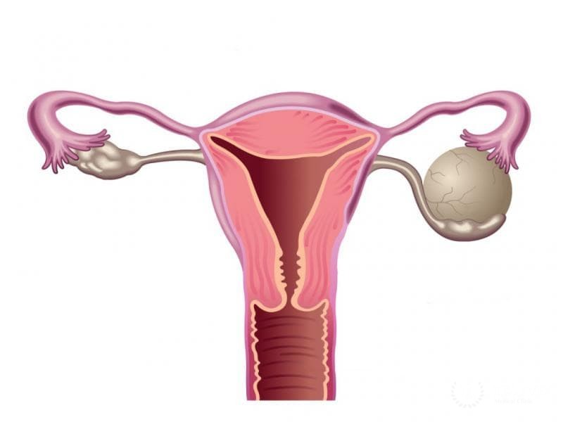 Образования яичников