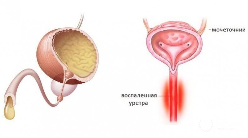 Клиника заболеваний уретры