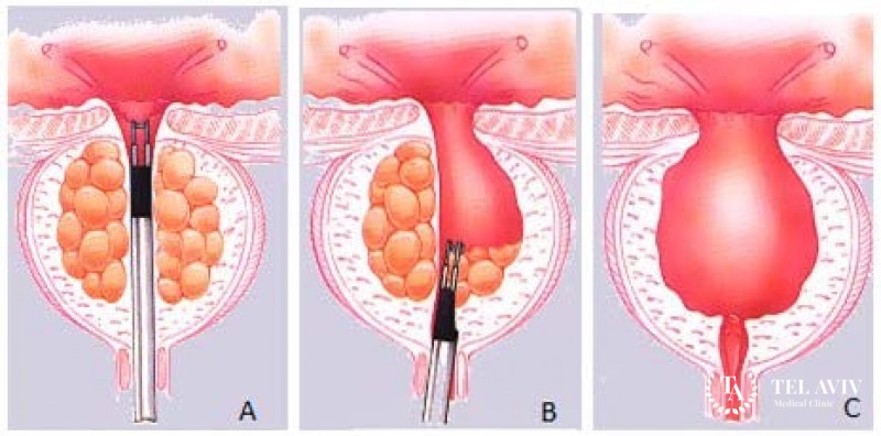 Трансуретральная резекция (ТУР) и Фульгурация