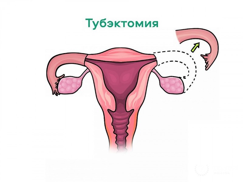 Тубэктомия – удаление маточной трубы