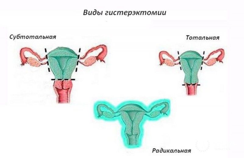 Тотальная абдоминальная гистерэктомия и двусторонняя сальпингоофорэктомия