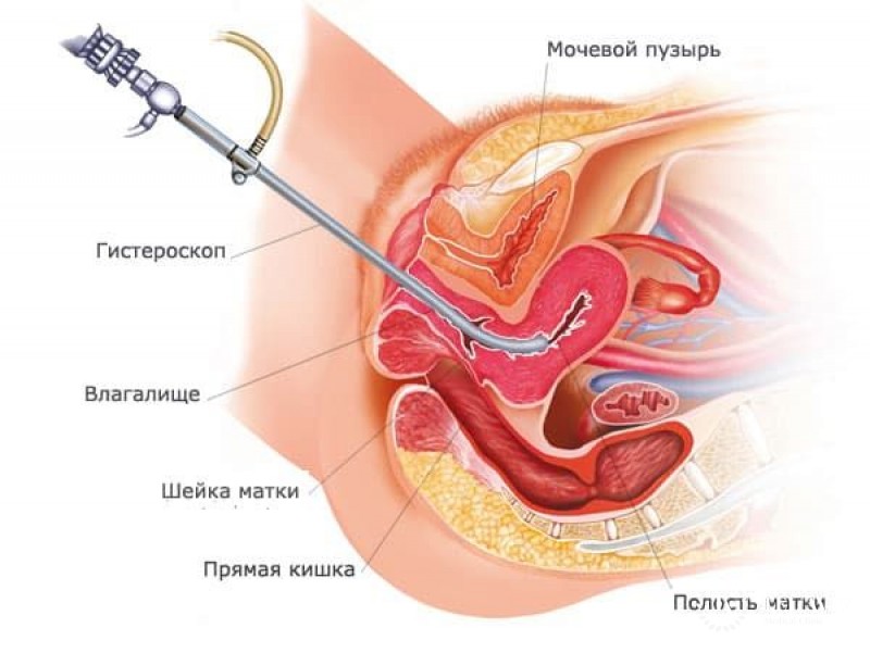 Гистероскопия