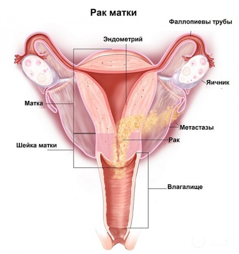 Клиника эндометрия и тела матки