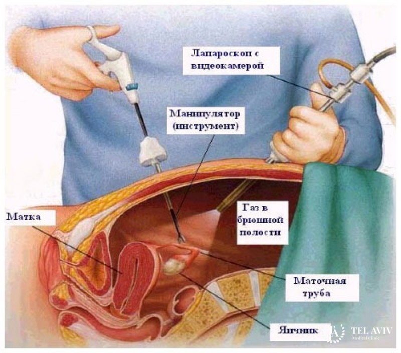 Аднексэктомия