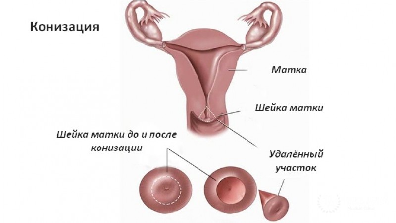 Конизация шейки матки