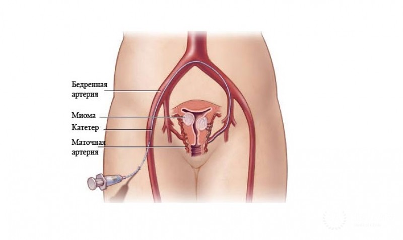 Эмболизация маточных артерий (ЭМА)