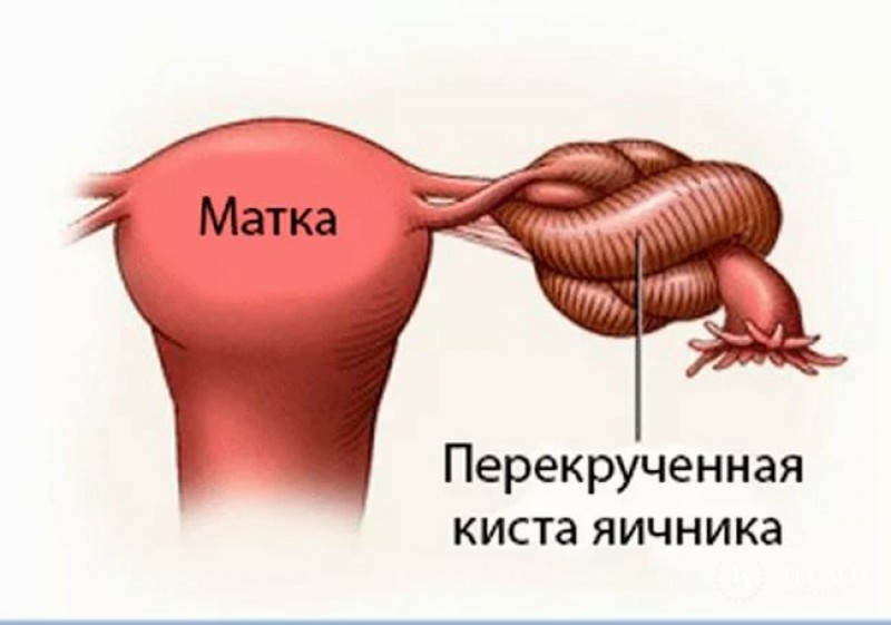 Перекрут придатков матки