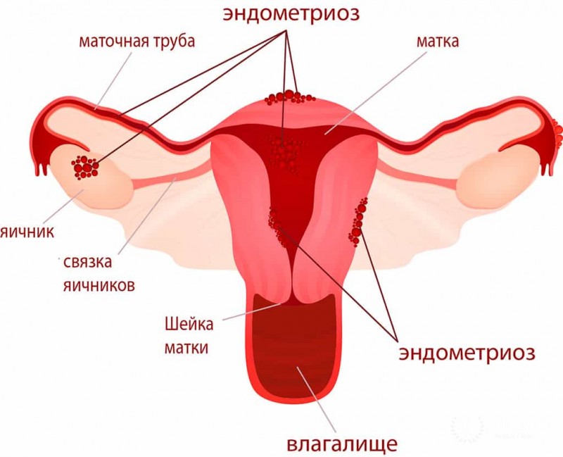 Эндометриоз