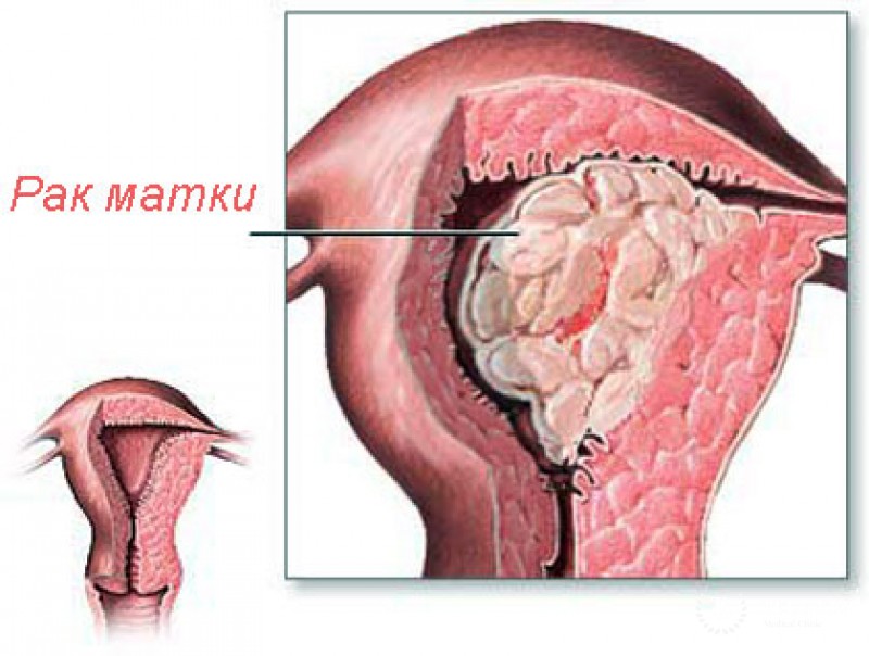 Карциномы матки