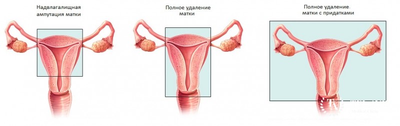 Надвлагалищная ампутация матки