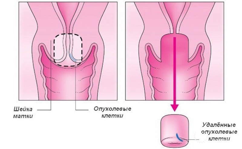 Удаление матки с шейкой (экстирпация)