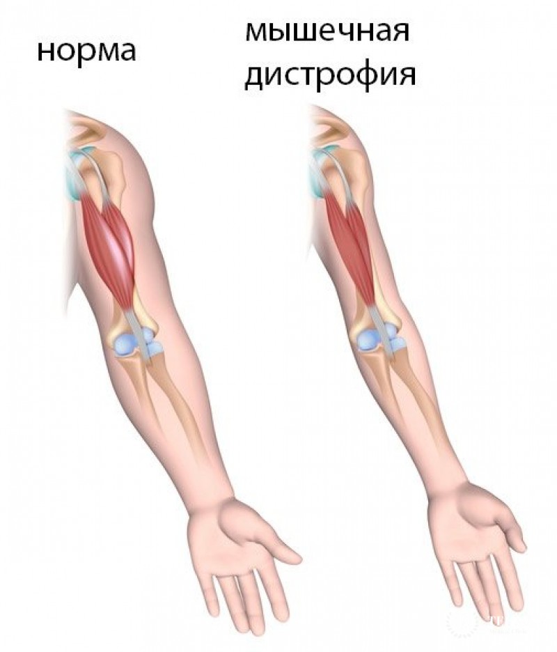 Миодистрофия Беккера