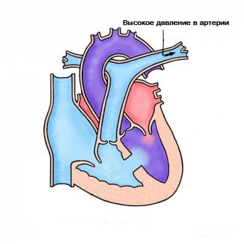 Комплекс Эйзенменгера у детей