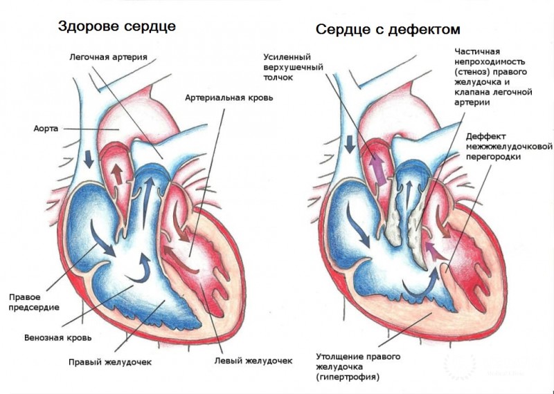 Дефект перегородки между аортой и лёгочной артерией