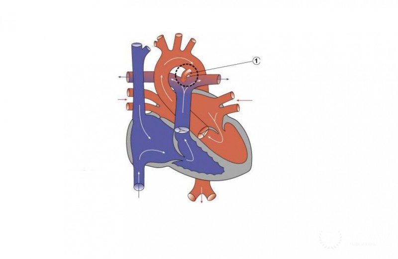 Коарктация аорты и открытый артериальный проток