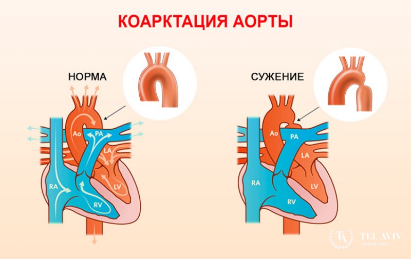 Коарктация аорты - полная информация