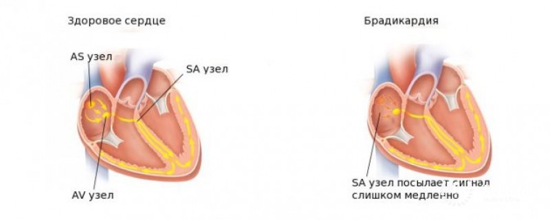 Брадикардии у детей