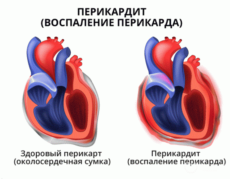 Перикардит у детей