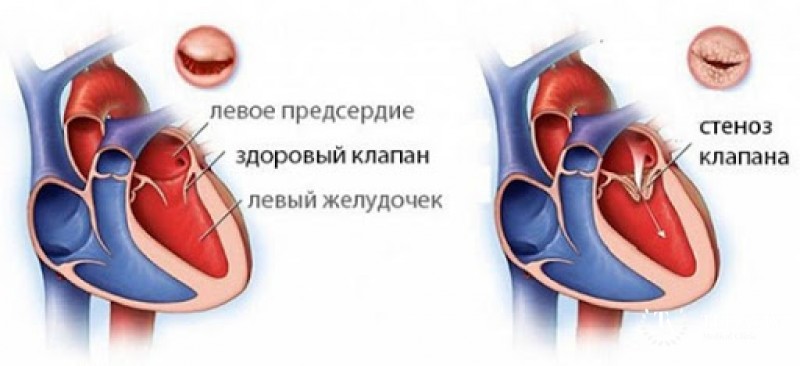 Искусственное стенозирование ЛА по Мюллеру-Альберту