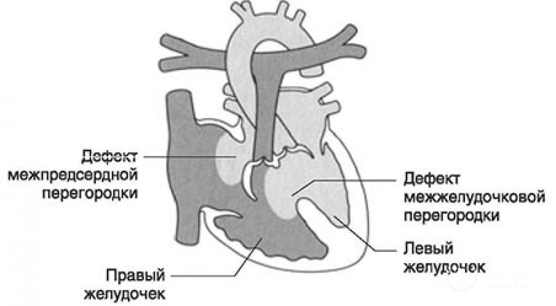 Коррекция дефекта предсердно-желудочковой перегородки