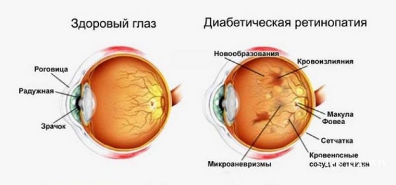 Ретинопатия недоношенных детей