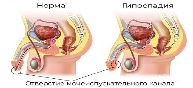 Гипоспадия у детей