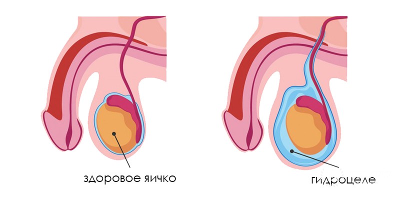 Врожденный Гидроцеле у детей