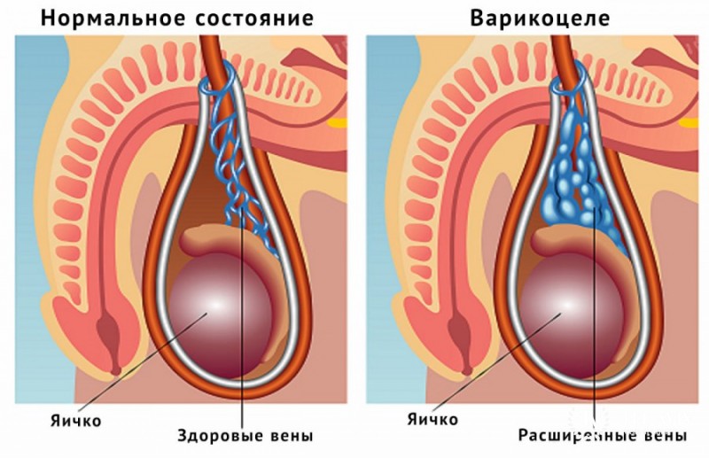 Варикоцеле у детей