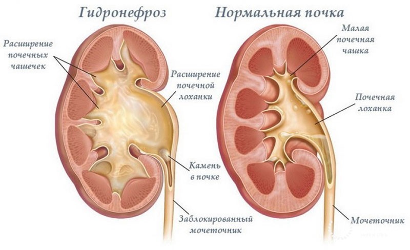 Расширение почечной лоханки плода