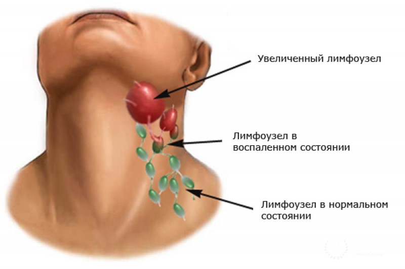 Лимфомы