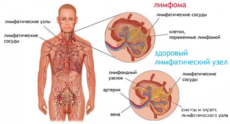 Лимфоплазмоцитарная лимфома