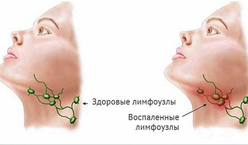 Мантийноклеточная лимфома