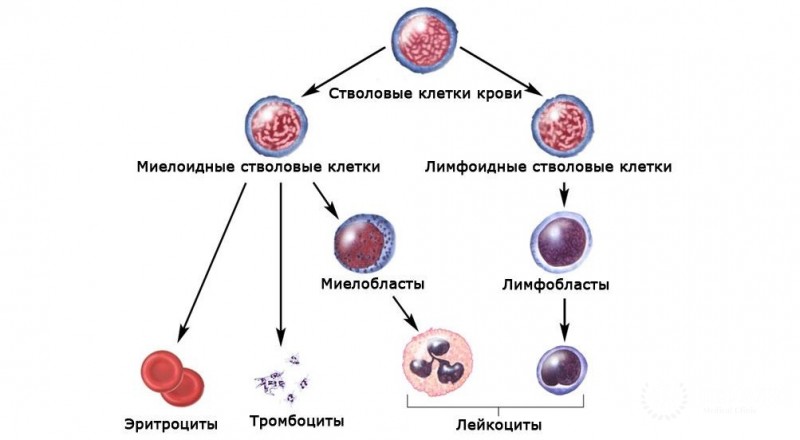 Острый миелоидный лейкоз