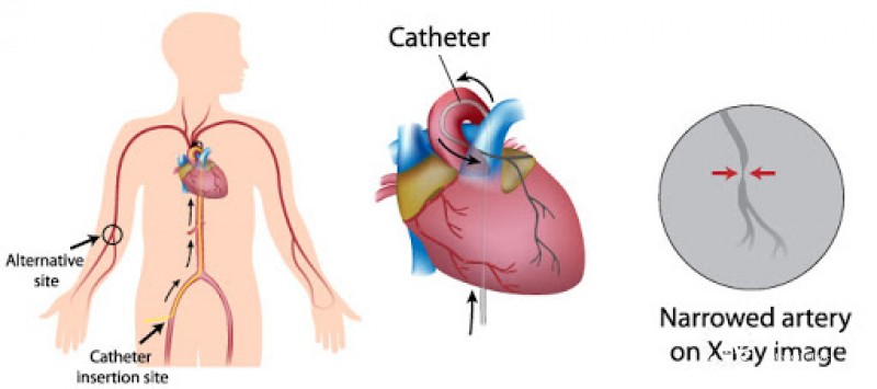 Diagnostic catheterization of the heart