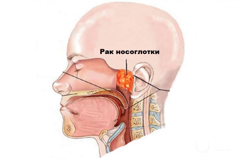 Рак носоглотки