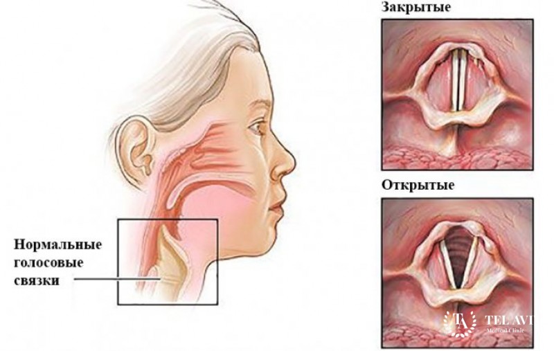 Киста голосовой связки
