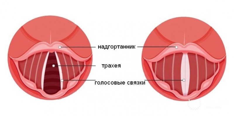 Полип голосовой связки