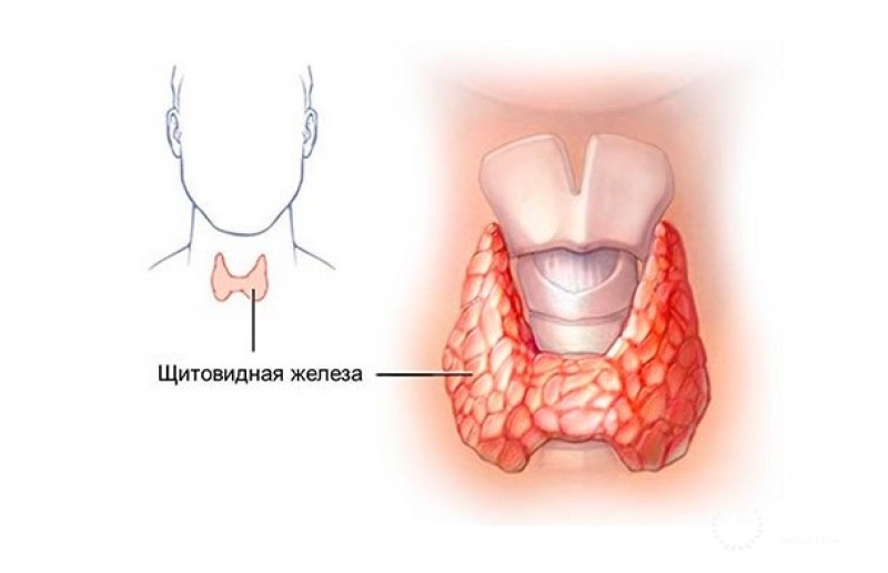 Лимфома щитовидной железы