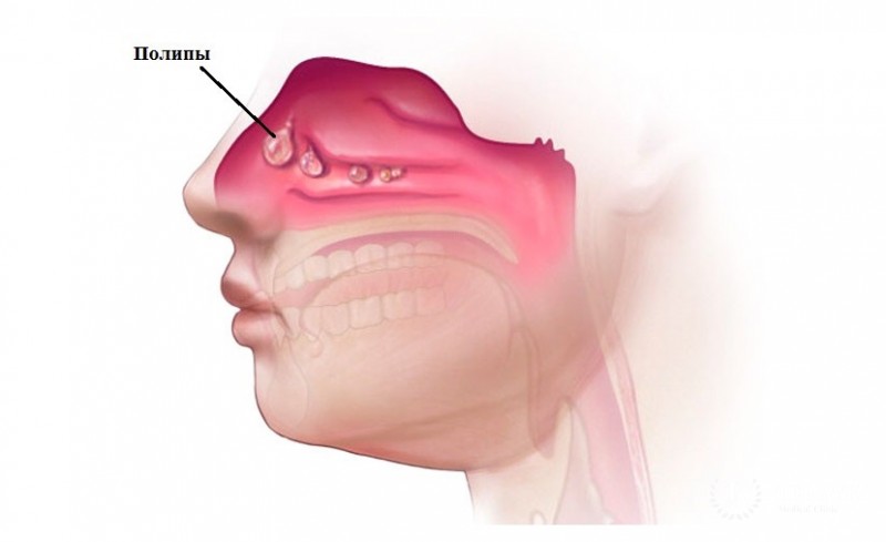 Аденома полости носа