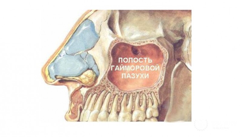 Рак гайморовых пазух