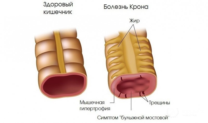 Болезнь Крона