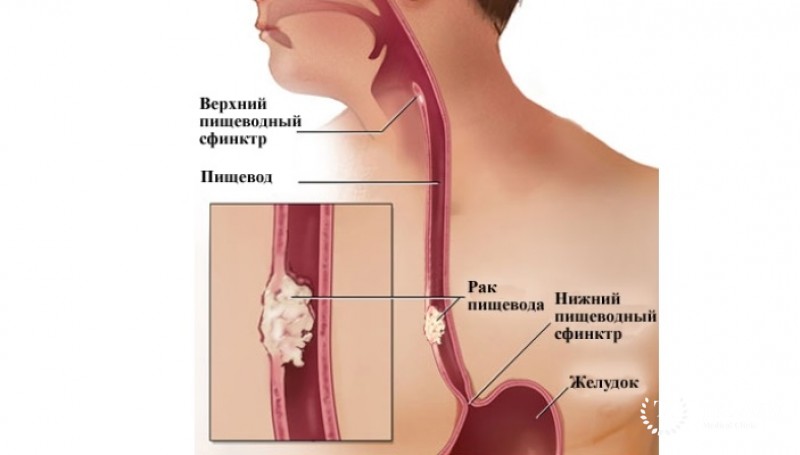 Аденокарцинома пищевода