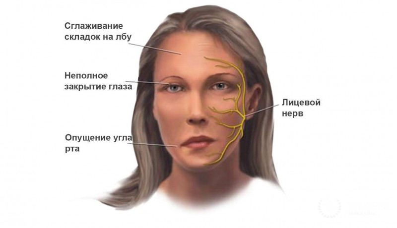 Миастения