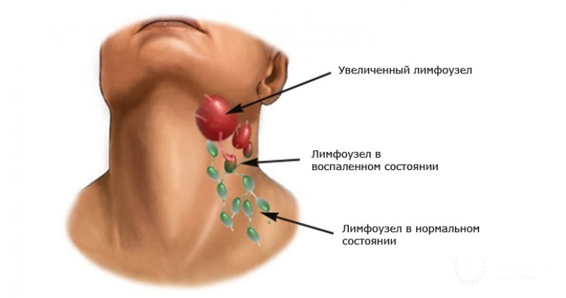 Лимфома Ходжкина