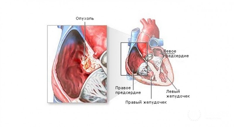 Фиброма сердца