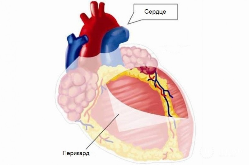 Перикардиальная мезотелиома