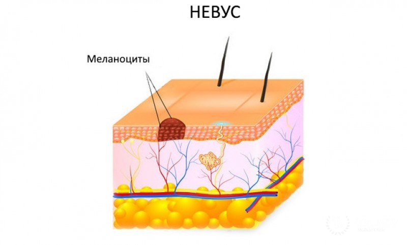 Родинки(невус)