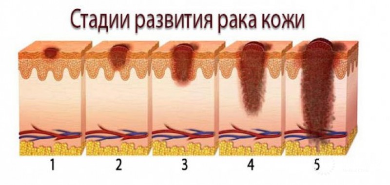 Узловая меланома (нодулярная)