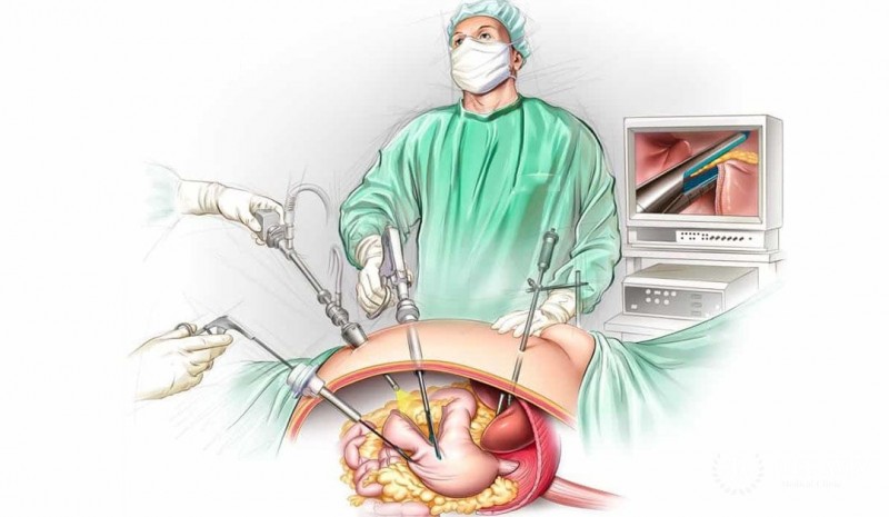 Gastrectomy